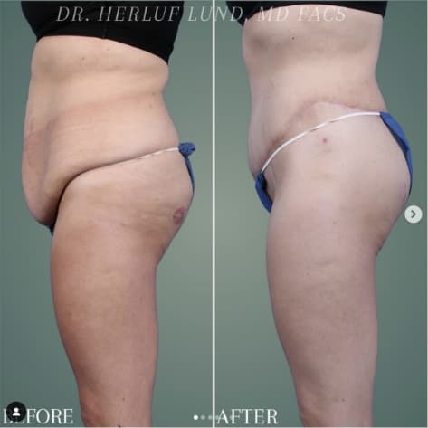 Before and After Body Procedure by Dr. Lund