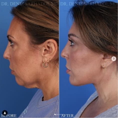 Face Procedure Before and After Done by Dr. Sarhaddi