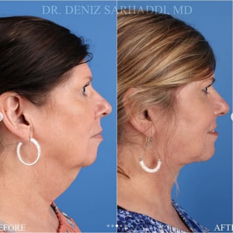 Face Procedure Before and After Done by Dr. Sarhaddi